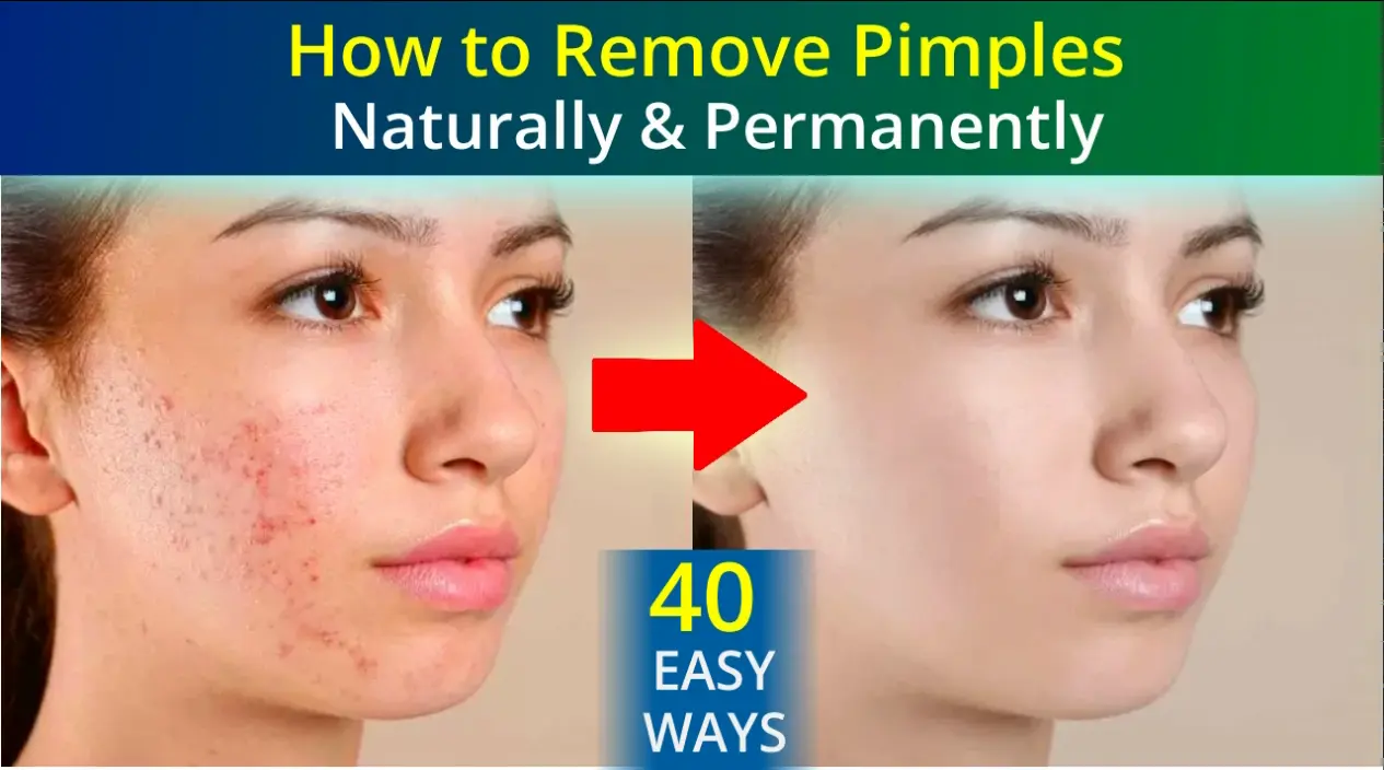 How to Remove Pimples Naturally and Permanently